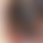 Auflichtmikroskopie, bläulich-/weißlich-opake Schleier. Auflichtmikroskopie (Ausschnitt: noduläre...