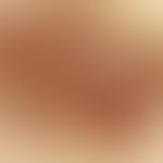 Incident light microscopy, melanophagus pseudotrabecula or diffusely distributed melanophagus tra...