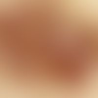 Auflichtmikroskopie, Melanophagen-Pseudotrabekel oder diffus verteilte Melanophagentrabekel. Aufl...