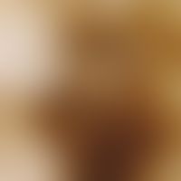 Auflichtmikroskopie, Melanophagenumsäumte Regressionszonen. Auflichtmikroskopie (Ausschnitt aus e...