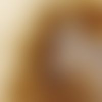 Auflichtmikroskopie, Melanophagenumsäumte Regressionszonen. Auflichtmikroskopie (Ausschnitt aus e...