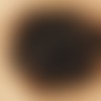 Auflichtmikroskopie, Pseudopodienartige Randzone. Auflichtmikroskopie: Schiefergraue Peudopodien ...