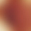 Auflichtmikroskopie, inverses (negatives) Pigmentnetz. Auflichtmikroskopie (5 mm großes noduläres...
