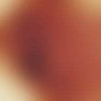 Incident light microscopy, inverse (negative) pigment network. incident light microscopy (5 mm no...