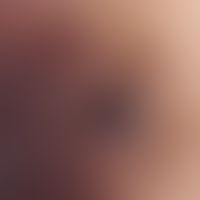 Reflected light microscopy, milky glassy bluish opaque areas with comedo-like keratin plugs. Deta...