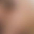Acne androgenetica. Mit praemenstrueller Verschlimmerung einhergehende, entzündliche Papeln in de...