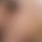 Acne androgenetica. Mit praemenstrueller Verschlimmerung einhergehende, entzündliche Papeln in de...