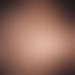 Effluvium, infektbedingtes. Akut-dystrophisches, parietales Effluvium bei einem 10-jährigen Mädch...