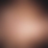 Effluvium, infection-related acute dystrophic parietal effluvium in a 10-year-old girl after high...