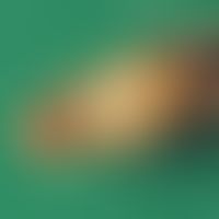 Anthrenus dermatitis; larva of the common carpet beetle (Anthrenus scrophulariae) collected from ...