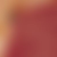 Auflichtmikroskopie, Basisarchitektur aus polymorphen und/oder aneurysmatischen Gefäßen. Auflicht...