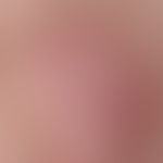 Reflected light microscopy, basic architecture of polymorphic and/or aneurysmatic vessels. reflec...
