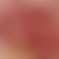 Auflichtmikroskopie, Basisarchitektur aus polymorphen und/oder aneurysmatischen Gefäßen. Auflicht...