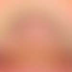 Torus palatinus: Hard, non-displaceable protrusion existing since birth, no longer progressive af...