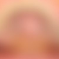 Torus palatinus: Hard, non-displaceable protrusion existing since birth, no longer progressive af...