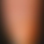 nicotine nail. yellow-brown discolouration of the index fingernail in a 61-year-old cigarette smo...