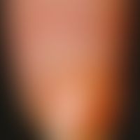 nicotine nail. yellow-brown discolouration of the index fingernail in a 61-year-old cigarette smo...