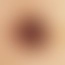 Black ink spot. reflected light microscopy (lesion in the area of the forehead in a 29-year-old w...
