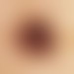 Black ink spot. Auflichtmikroskopie (Läsion im Bereich der Stirn bei einer 29-jährigen Frau): 2,2...