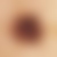 Black ink spot. Auflichtmikroskopie (Läsion im Bereich der Stirn bei einer 29-jährigen Frau): 2,2...