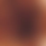 Black ink spot. Auflichtmikroskopie (Detailvergrößerung einer Läsion im Bereich der Stirn bei ein...