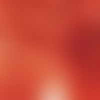 reflected light microscopy, grey-blue follicular pigment ring. reflected light microscopy: detail...