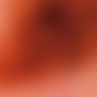 Incident light microscopy, grey-blue follicular pigment ring. Incident light microscopy: Detail o...