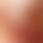Auflichtmikroskopie, Ehringsche Rhexisblutung. Auflichtmikroskopie: Nagelfalz bei einer 63-jährig...