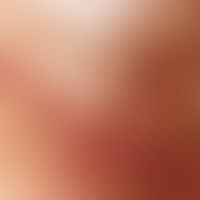 Incident light microscopy, Ehring's rhexis hemorrhage. Incident light microscopy: Nail fold in a ...