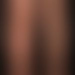 lymphedema secondary: diffuse, uniform swelling of the left lower extremity. if the patient stand...