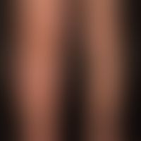 lymphedema secondary: diffuse, uniform swelling of the left lower extremity. if the patient stand...