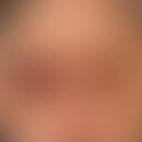 Raccoon-Sign (Spectacle Hematoma): several, chronically active, periorbital located, symmetrical,...