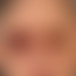 Raccoon-Sign (Spectacle Hematoma): several, chronically active, periorbital located, symmetrical,...