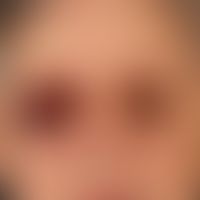 Raccoon-Sign (Brillenhämatom): mehrere, chronisch aktive, beidseits periorbital lokalisierte, sym...