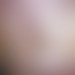 Hämatom, Nagelhämatom. Nagelveränderung nach geringfügigem Quetschtrauma. Streifenförmige, rote u...