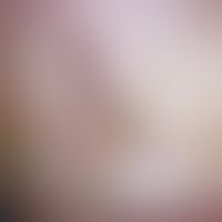 Hämatom, Nagelhämatom. Nagelveränderung nach geringfügigem Quetschtrauma. Streifenförmige, rote u...