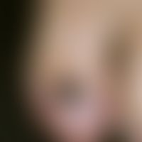 hematoma, nail hematoma. blue-blackish, sharply defined pigmentation (here of the big toe nail) d...