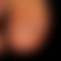 Nail hematoma: sharply limited brownish discoloration of the nail; no streaky distal pigmentation...