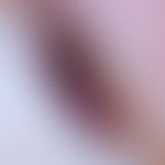 Hämatom, Nagelhämatom. Auflichtmikroskopie mit rot- blauer&nbsp;Verfärbung des Nagels.
