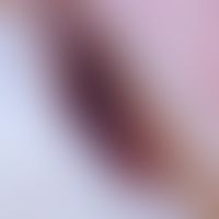 Hämatom, Nagelhämatom. Auflichtmikroskopie mit rot- blauer&nbsp;Verfärbung des Nagels.
