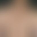Induration: Multiple, chronically dynamic, long-standing, size-progressive, irregularly bordered,...