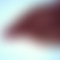 Dicrocoeliasis. Dicrocoelium dendriticum: adulter Wurm. Im hinteren Ende befinden sich der Uterus...