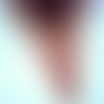 Clonorchiasis. Clonorchis sinensis: adult worm. The anterior section shows genital opening and ab...