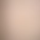 Linea fusca. sharply defined, linear, brown, smooth, non-pruritic hyperpigmentation in a 28-year-...