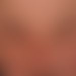 Lidschwellung; massive beidseitige&nbsp;Lidödeme nach beidseitiger&nbsp;Blepharoplastik.&nbsp;
