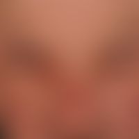 Lidschwellung; massive beidseitige&nbsp;Lidödeme nach beidseitiger&nbsp;Blepharoplastik.&nbsp;
