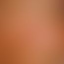 Dufourmentel?transposition flap. Fig. 1 a: Sharply defined, slightly sunken erosive round focus c...