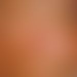 Dufourmentel?transposition flap. Fig. 1 a: Sharply defined, slightly sunken erosive round focus c...