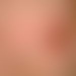 Dufourmentel?transposition flap. fig. 2 a: hemispherically above the skin level raised coarse tum...