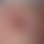 Limberg transplant flap. fig. 2 a: Semi-circularly limited, irregularly brown pigmented plaque wi...